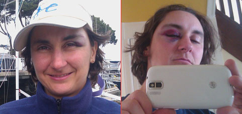 Nathalie's black eye